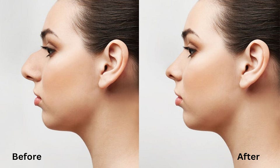 Discovering Non-Surgical Nose Jobs in Massachusetts 
